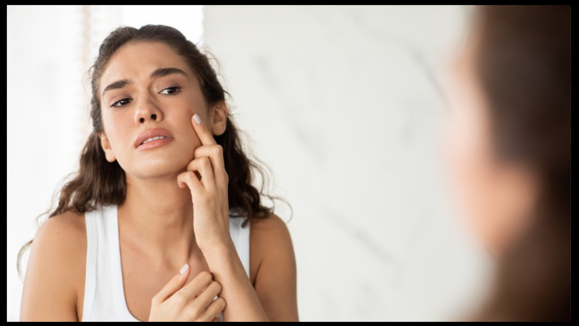 Relentless Acne Problem? Understand the reasons and treatment.