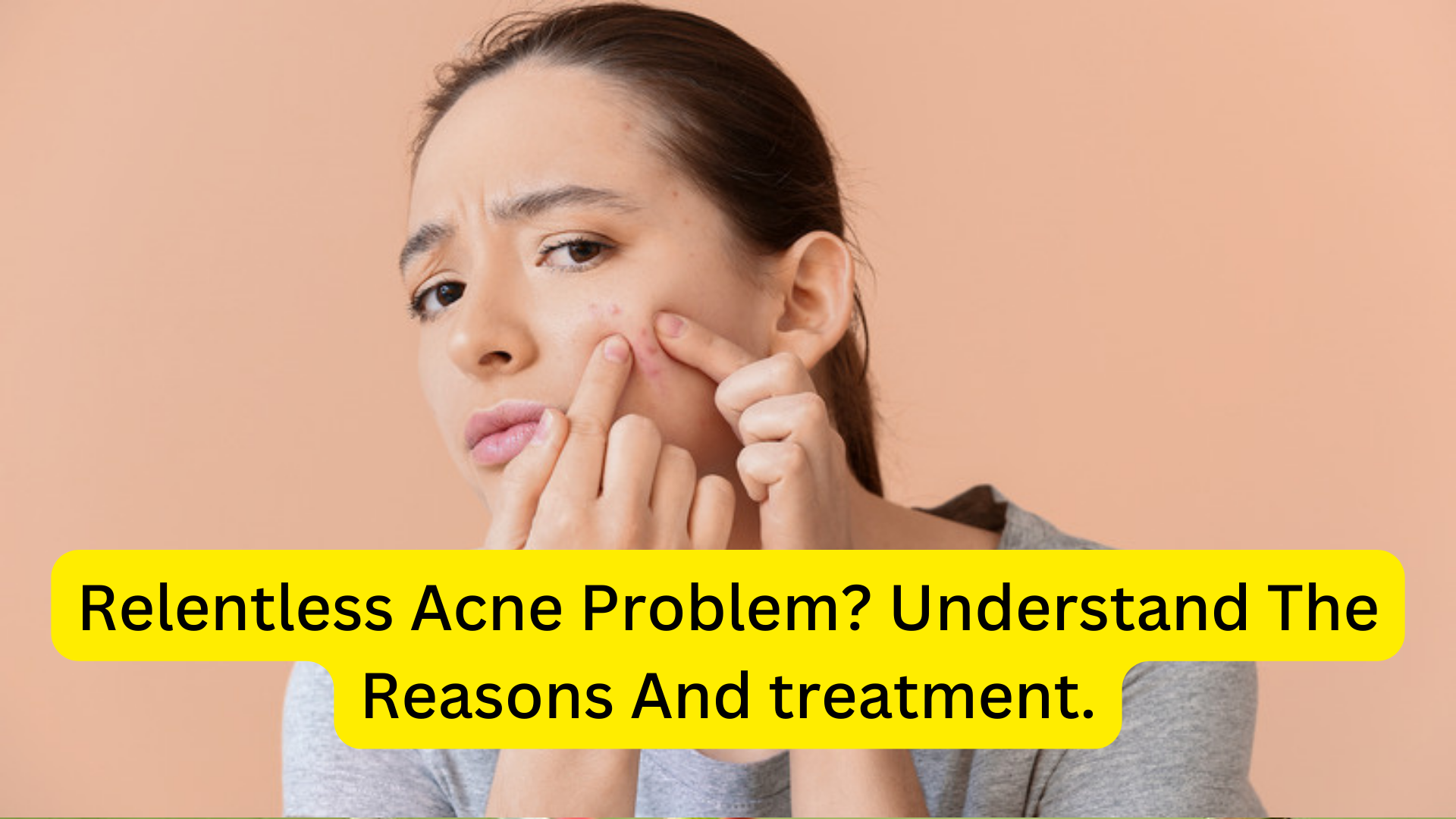 Relentless Acne Problem? Understand the reasons and treatment.